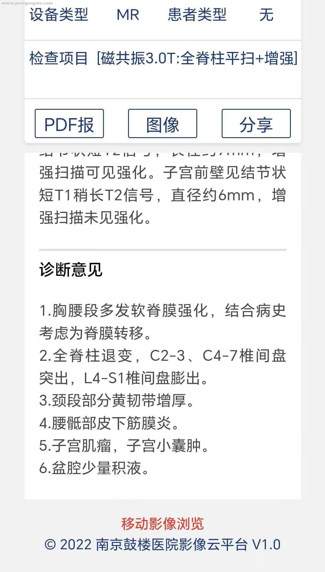 肺癌术后五年，脑膜转移治疗三年，伏美替尼6粒，脊膜转移，脑萎缩