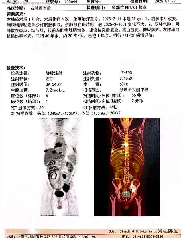 术后四化单免一年不到骨转淋巴转胸膜转